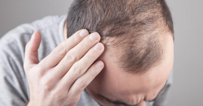 Hairfall: Why does hair fall and what is the reason for baldness, know 5 major reasons