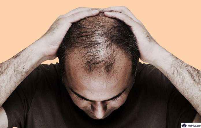 Home remedy to stop hair fall: Hair fall and baldness will not occur throughout life, start applying these home remedies from today