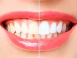 Tips To Whiten Teeth : Black and yellow teeth will start shining like pearls, just use these 3 things kept in the house, even doctors will be surprised