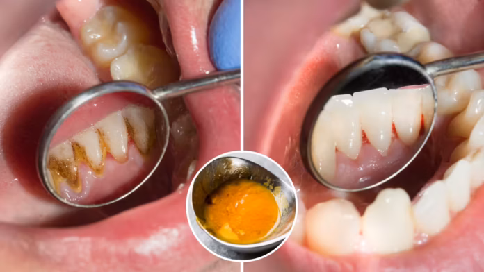 These two things will clean the yellow layer on teeth, strengthen them, experts told how to use them.