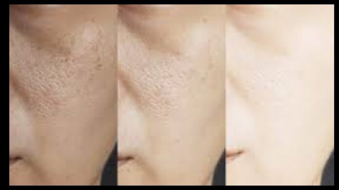 Looking to get rid of open pores and dry skin this winter? Learn these 5 great home remedies for glowing skin.